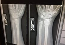 How to File a Workers’ Compensation Claim in California xray broken arms work injury